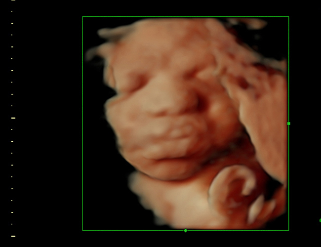 3D ultrasound image at 30 weeks